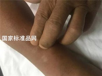 被蜱蟲咬傷喪命